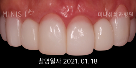 잇몸 내려앉음, 잇몸퇴축 원인과 치료 방법은? 관련 이미지 6