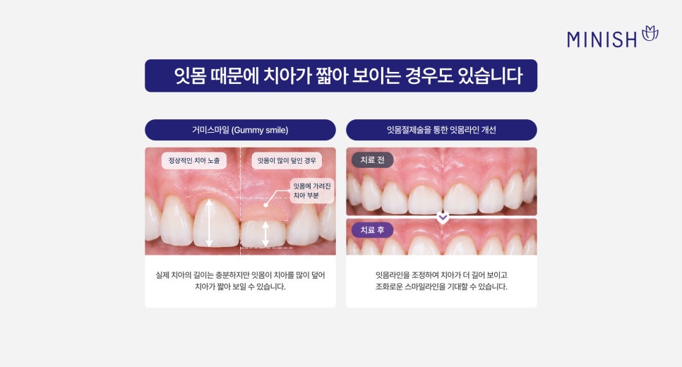앞니가 짧아 보인다면? 짧은치아 원인과 앞니 미니쉬 관련 이미지 4