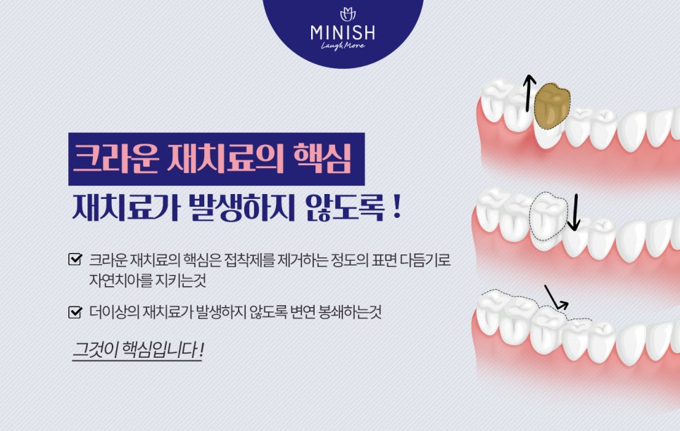 오래된 크라운 재치료가 시급하다면, 미니쉬치과 관련 이미지 4
