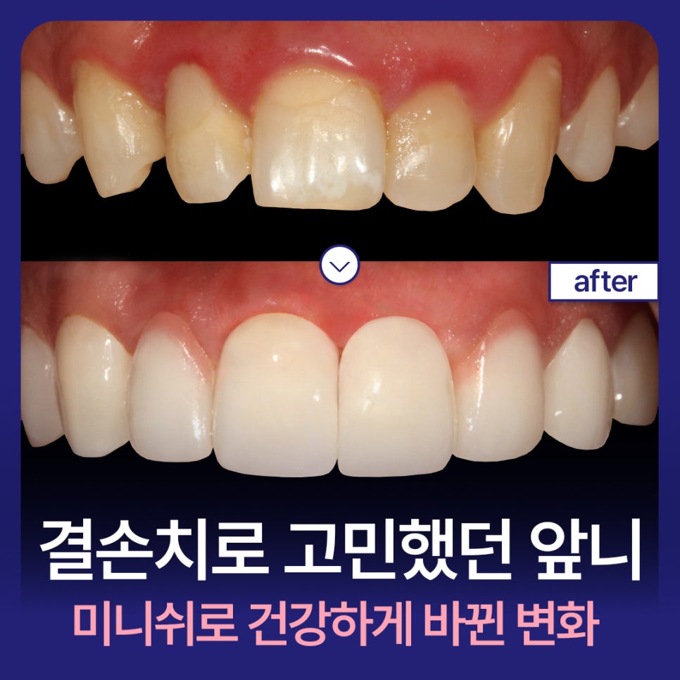 The front teeth I had worried about because of missing teeth, transformed healthily with MINISH image 1