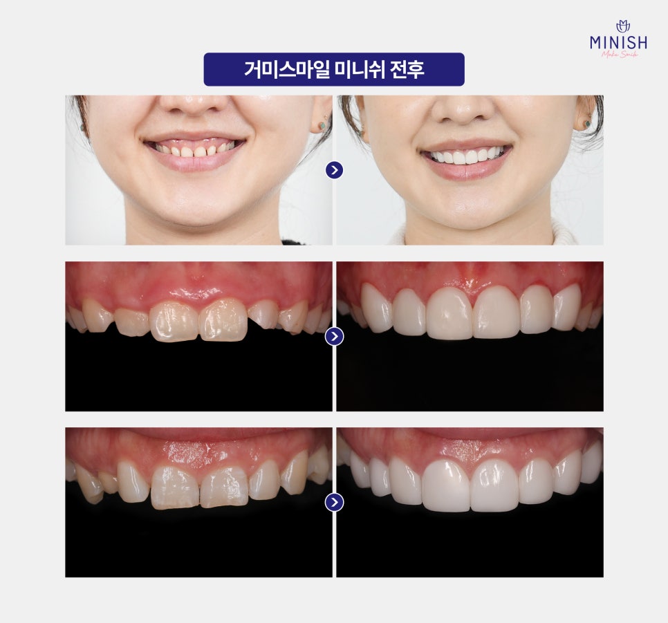 Gummy Smile: Why the Gums Show So Much When You Smile and How to Improve It image 6
