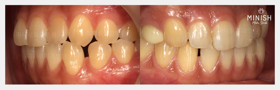 벌어진 치아로 잃어버린 자신감, 미니쉬로 되찾다 관련 이미지 2