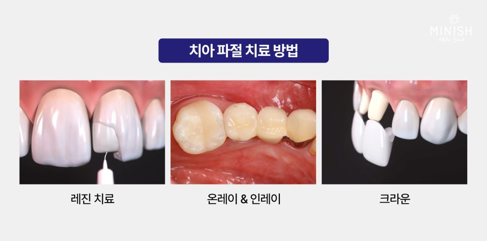 What If a Tooth Breaks? A Complete Summary of Tooth Fracture Treatment Methods and Their Pros and Cons image 3
