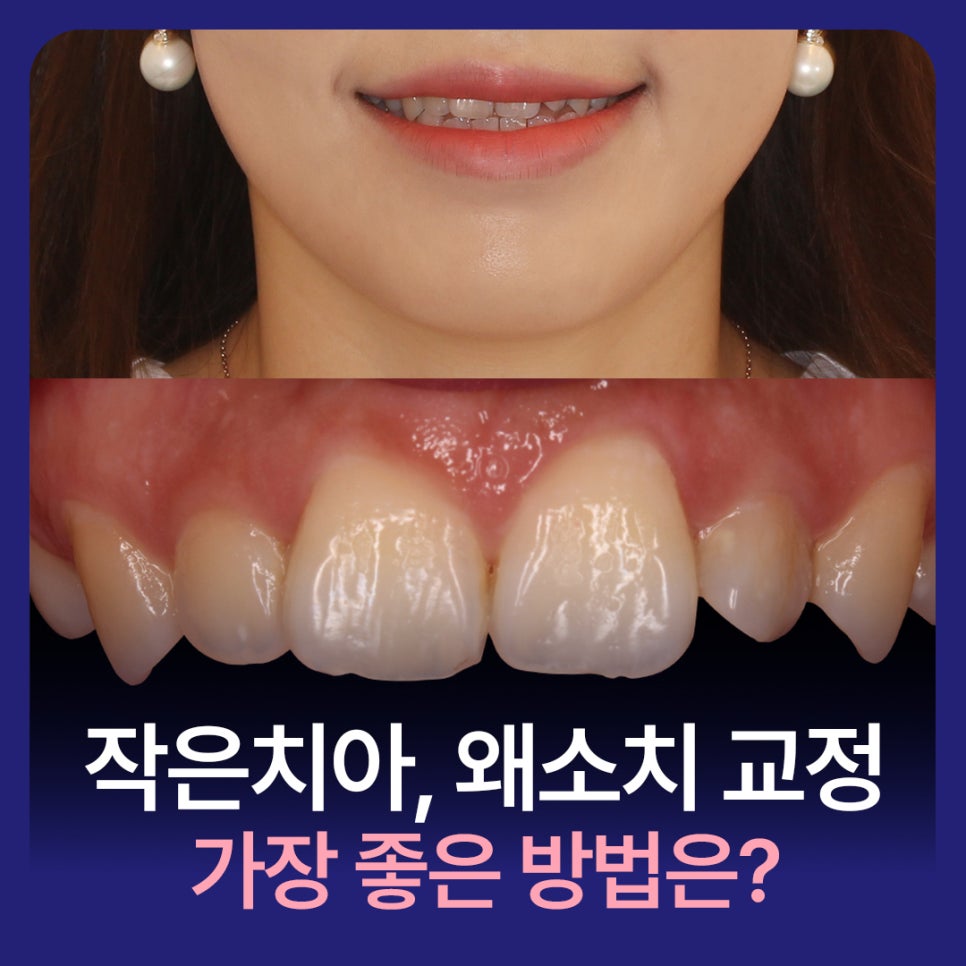 작은치아 왜소치 교정 가장 좋은 방법은? 관련 이미지 1