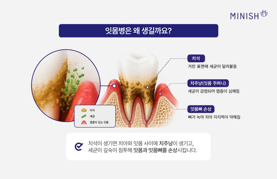 치석 제거 안 하면? 잇몸병 단계별 증상 및 치료 방법 관련 이미지 3