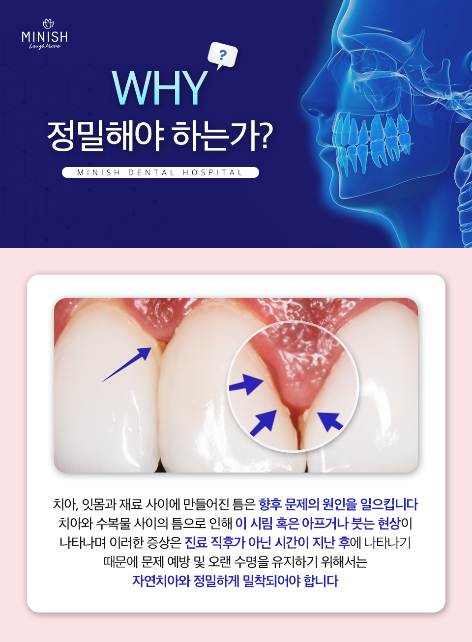 미니쉬후기 통해 벌어진 앞니 고민 끝 ! 관련 이미지 4