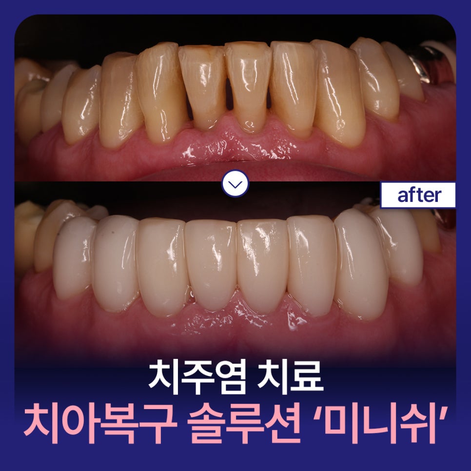 치주염 치료, 미니쉬가 제안하는 건강한 치아복구 솔루션 관련 이미지 1
