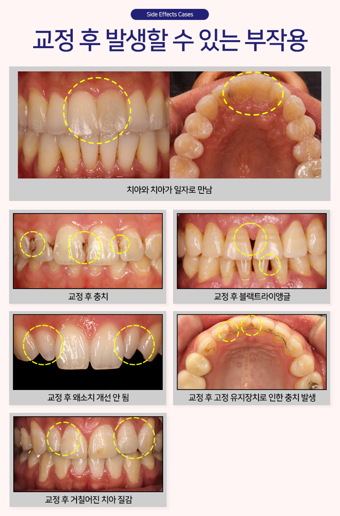 Is It Possible to Straighten Teeth in Just One Day? image 7