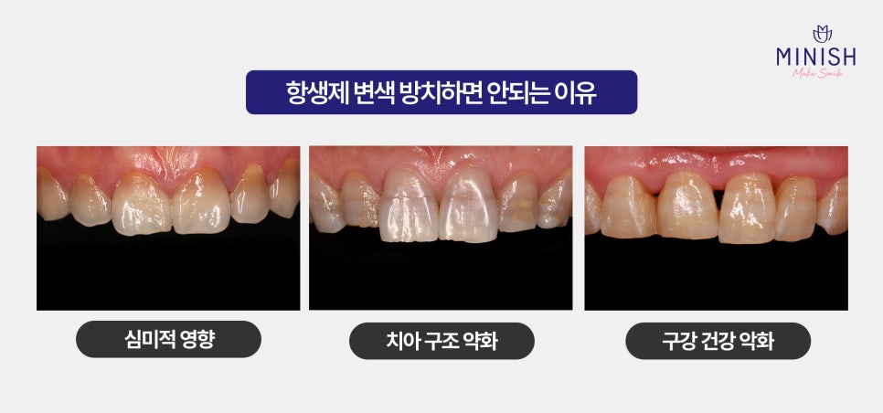 Antibiotic-Discolored Teeth Can Be Treated with MINISH! image 4