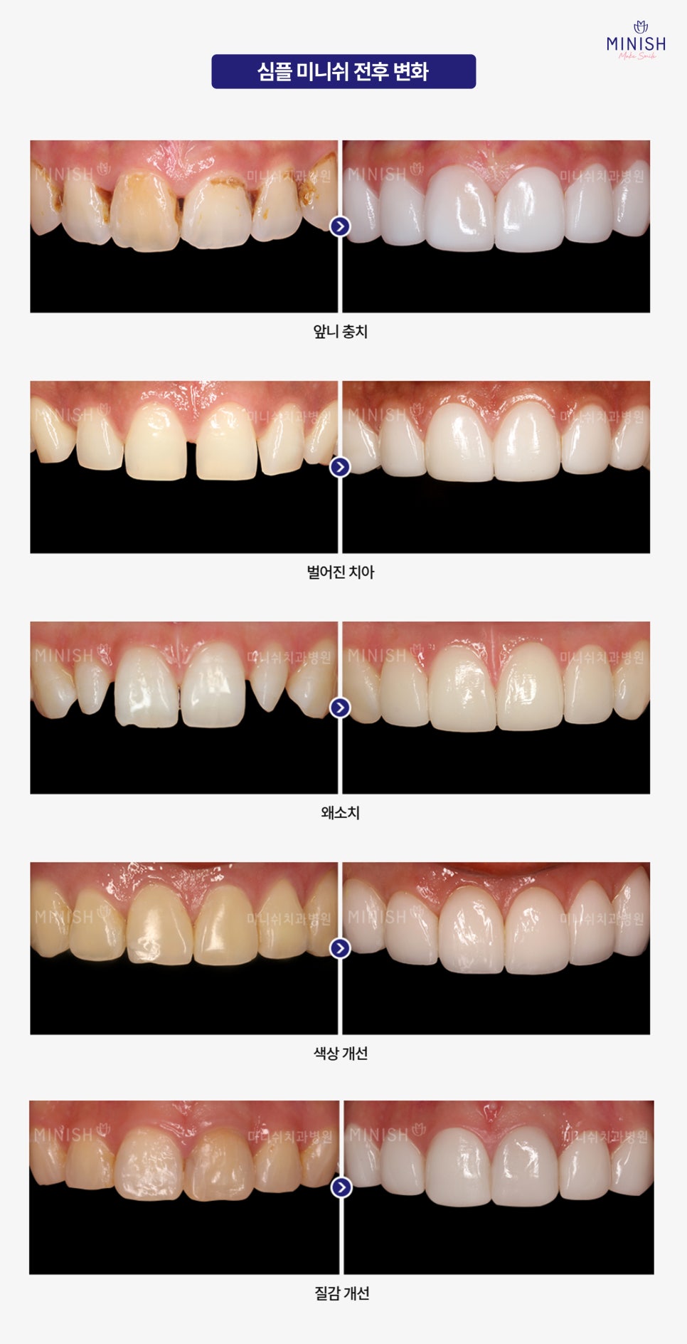 A Complete Guide to the Minish Program That Fits My Teeth image 4
