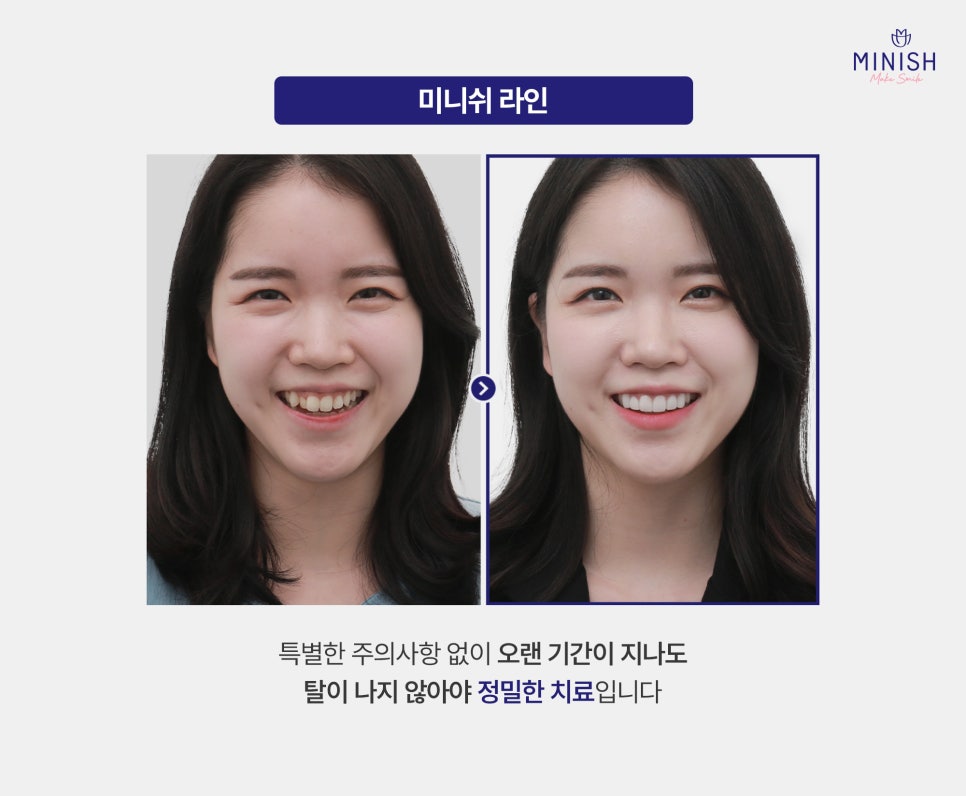 Crooked Front Teeth and the Butterfly Teeth Complex: Why Improving Tooth Shape and Proportions Matters / Minish Line image 6