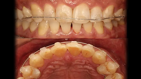 Orthodontics Without Tooth Reduction! Pre Align image 2