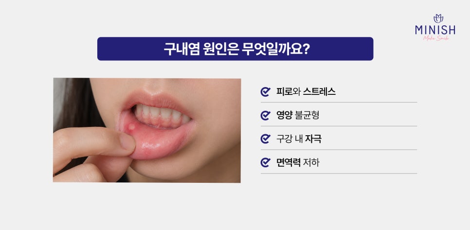 구내염 원인부터 빨리 낫는 법까지, 자꾸 생기는 이유는? 관련 이미지 3