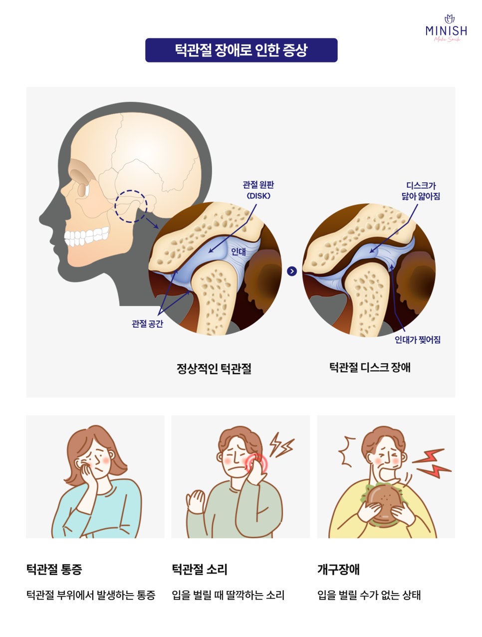 Bruxism and TMJ: If Left Untreated, Both Your Teeth and Joints Could Be at Risk image 4