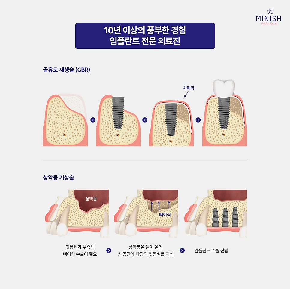 Implants, Only When Truly Necessary! Minish Dental Hospital’s Treatment Process for Protecting Natural Teeth image 8