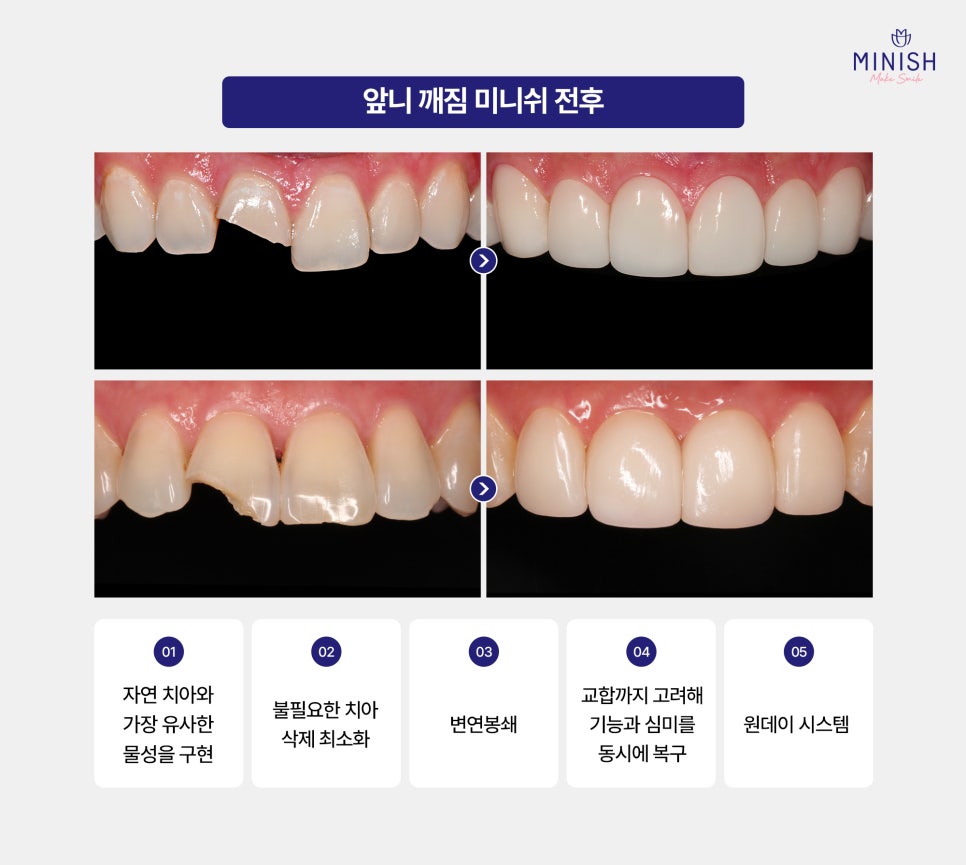 What Problems Can Occur If a Chipped Front Tooth Is Left Untreated, and How Can It Be Restored to Look Like a Natural Tooth? image 5
