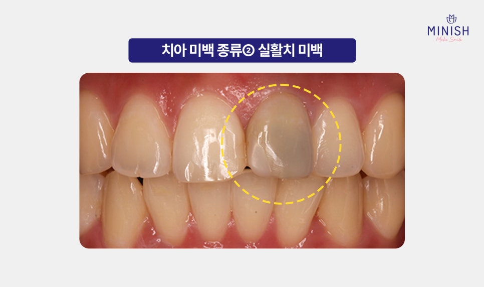 Yellow Teeth Concerns: Teeth Whitening Methods That Vary by Cause image 9