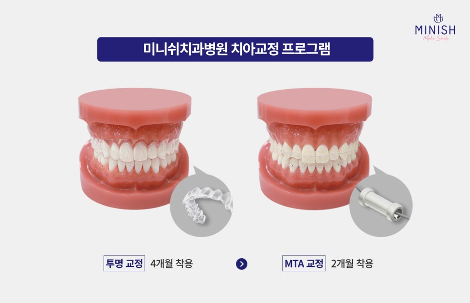 A Complete Guide to Adult Orthodontic Types: Which Method Is Right for Me? image 4