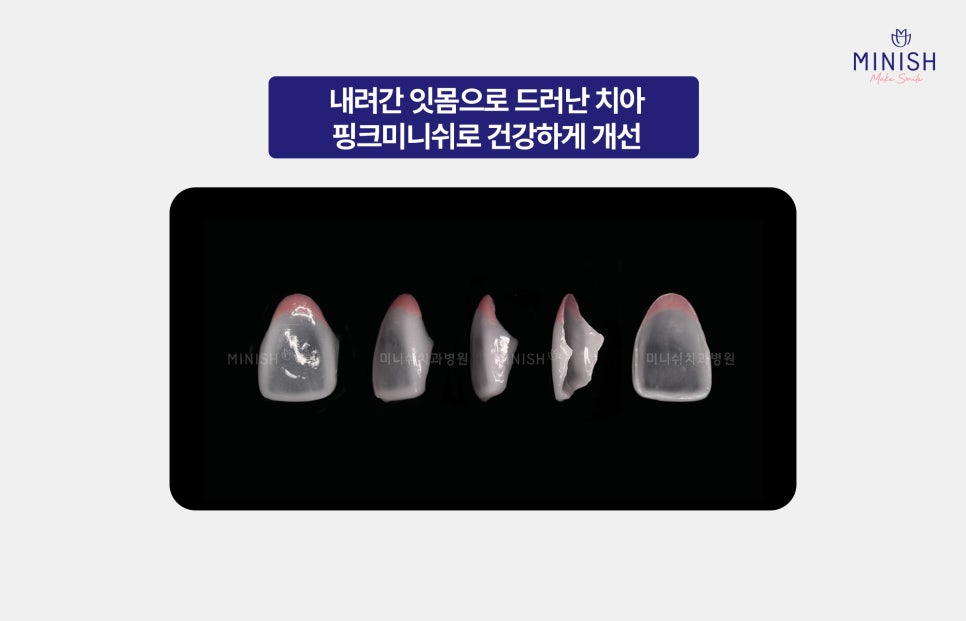 If You Miss the Warning Signs of Gum Disease, It Becomes Hard to Reverse. What Is the Right Treatment Method? image 4