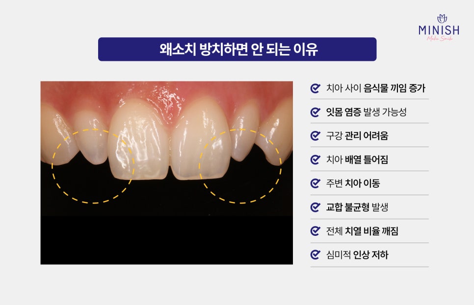 작은 치아, 왜소치 고민이라면? 하루 만에 개선할 수 있습니다 관련 이미지 2