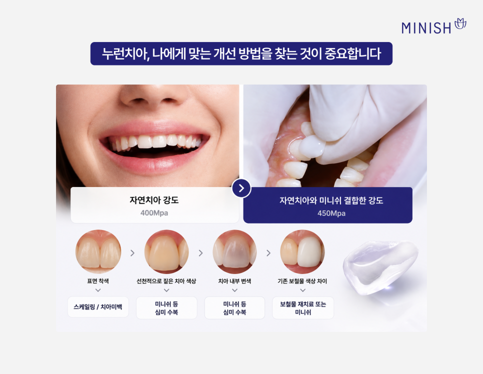 치아미백으로 해결 안 되는 누런치아, 하얗게 하려면? 관련 이미지 7