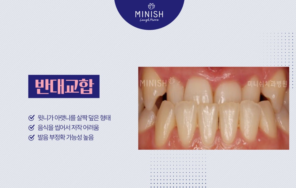 부정교합종류, 하루만에 교정할 수 있는 방법도 있을까? 관련 이미지 5