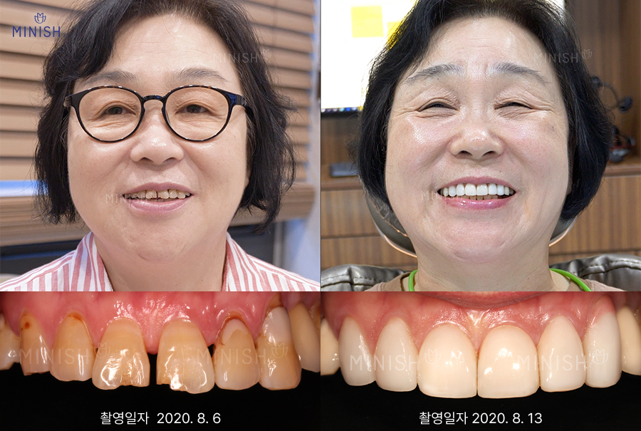 치아마모, 치아노화 증상 치료 치아 안티에이징으로 해결 관련 이미지 3