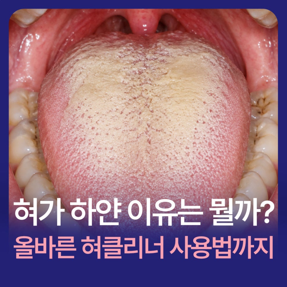 혀가 하얀이유는 뭘까? 혀설태 원인과 혀클리너 사용법 정리 관련 이미지 1