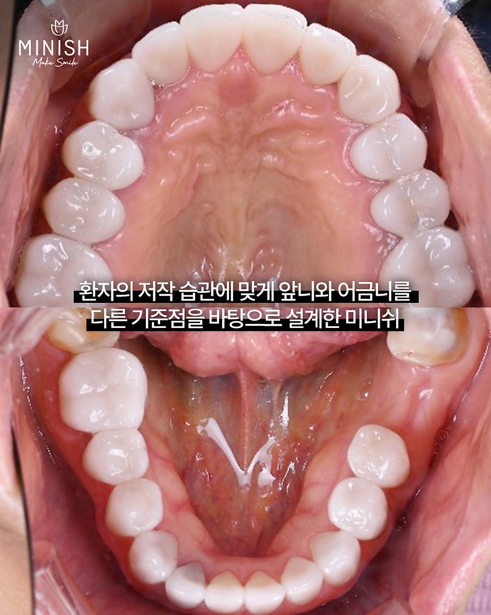 If Your Teeth Have Worn Down and Even Changed Your Face, Can They Be Restored? A Case Repaired with Minishe image 6