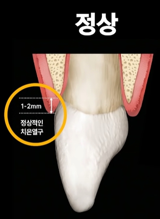 잇몸염증은 구강 적신호...가장 적극적인 잇몸치료는 미니쉬 관련 이미지 3