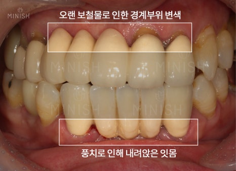 꽃게엄마와 딸의 치아 관련 이미지 7