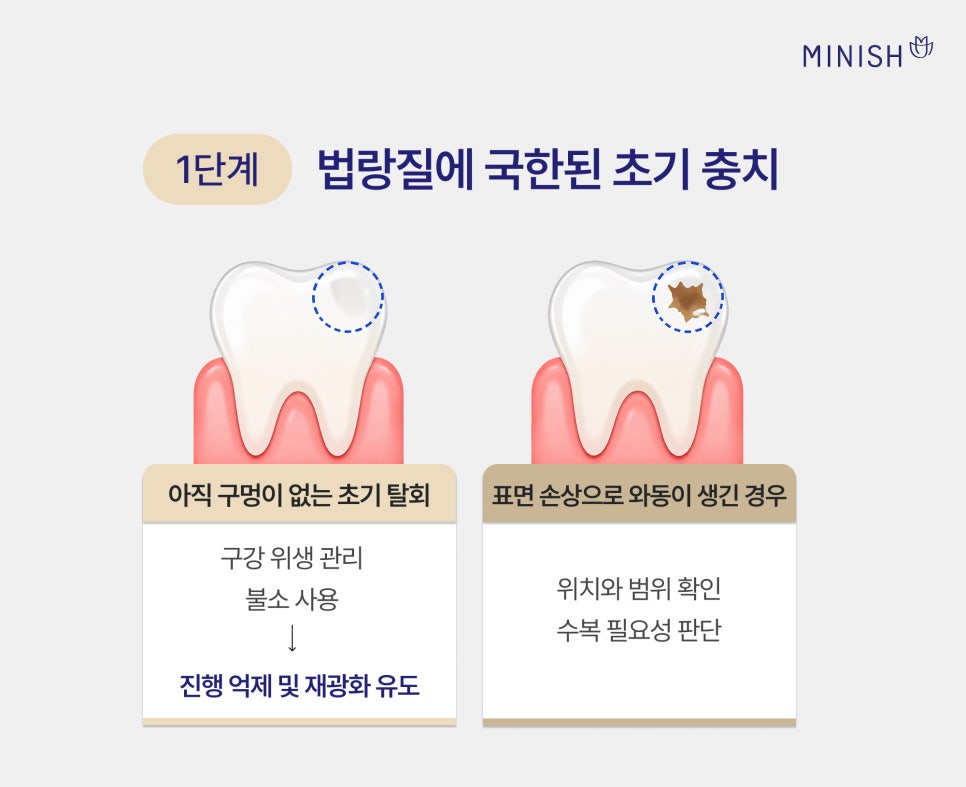 충치 단계별 치료 방법, 원데이 치료로 하루 만에 가능할까? 관련 이미지 3