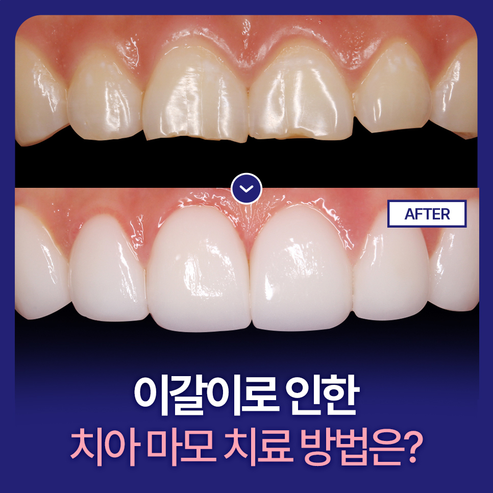 이갈이로 인한 치아마모, 미니쉬로 해결하세요! 관련 이미지 1