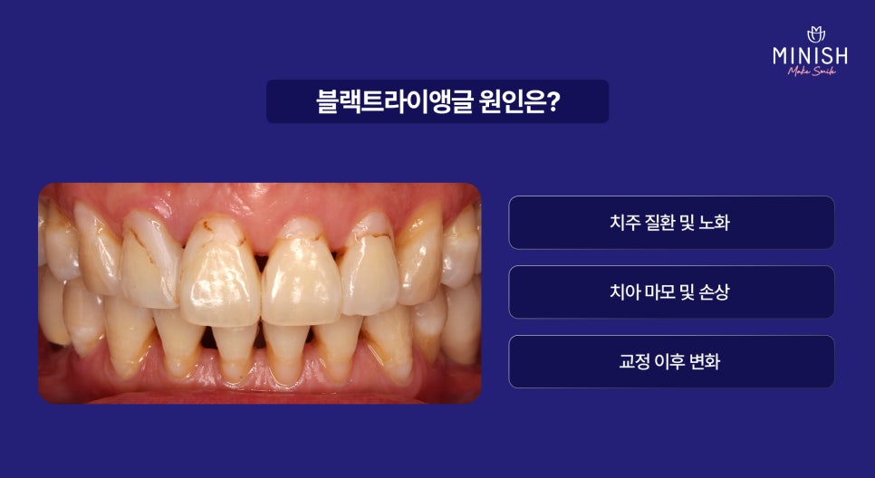 Black Triangles Between Teeth: Restore Them Healthily with Minishe! image 2