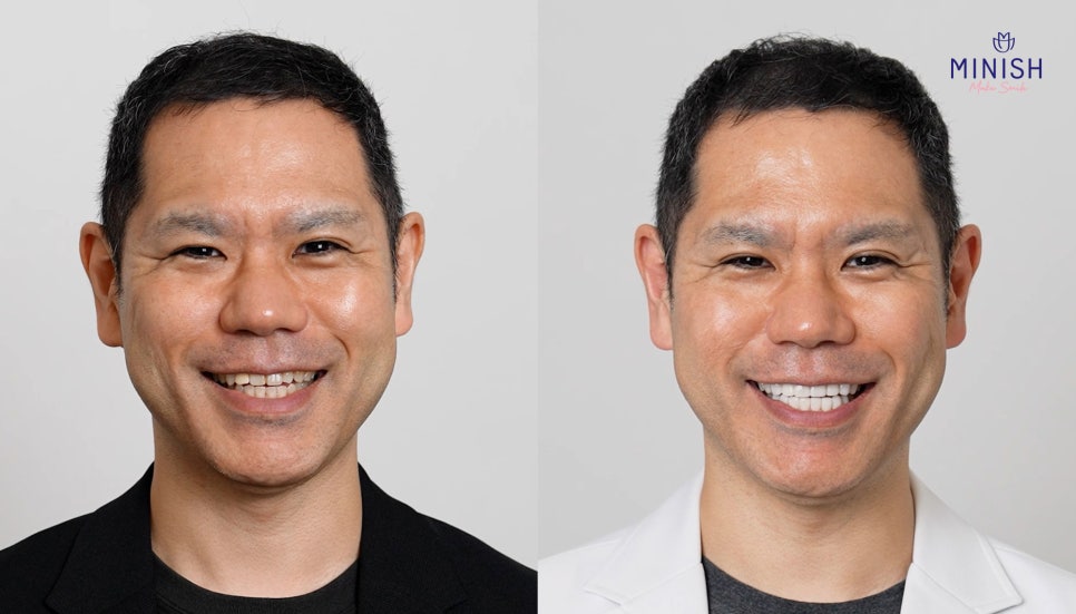 Chosen Directly by Japan’s Top Invisalign Dentist image 2