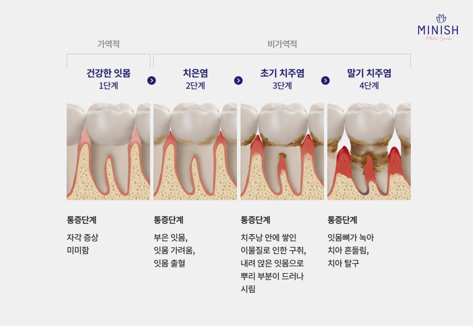 풍치치료 한계 잇몸내려앉음 핑크미니쉬로 해결! 관련 이미지 3