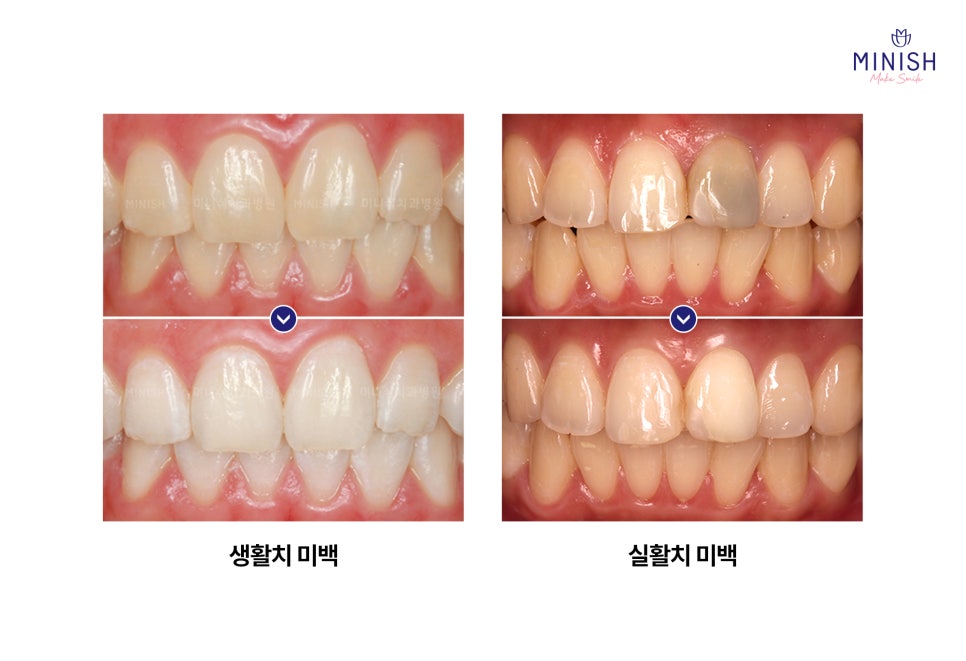 누런 치아? 치아변색 원인과 치료방법은? 관련 이미지 6