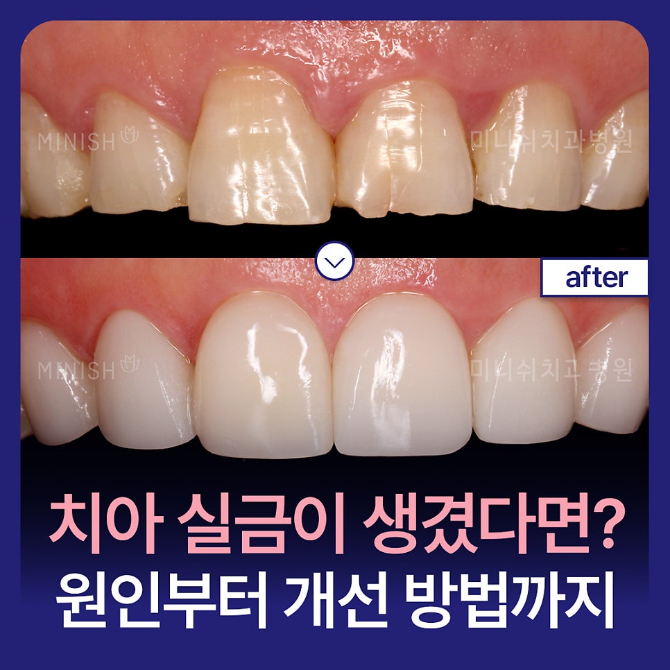 Have a Tooth Crack? You Shouldn’t Ignore It! From Causes to Improvement Methods image 1