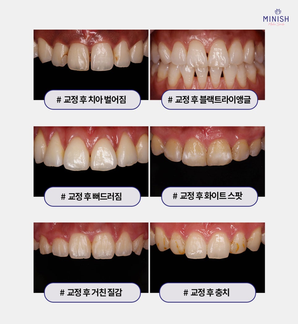 잘 보이지 않는 투명교정 하기 전에 알아두면 좋은 점 관련 이미지 5