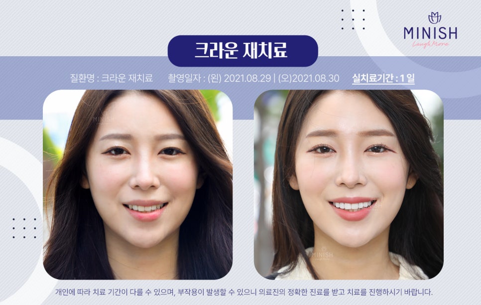 오래된 크라운 재치료가 시급하다면, 미니쉬치과 관련 이미지 1