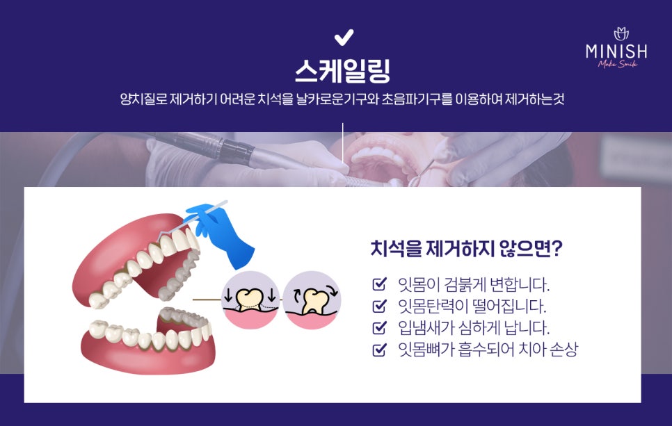 스케일링 주기, 1년에 몇 번 하는게 좋을까? 관련 이미지 2