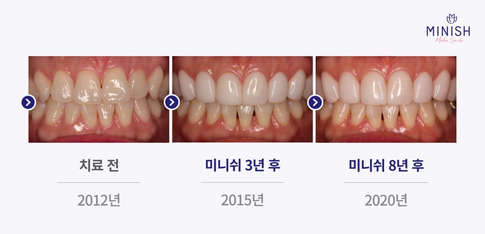 이갈이로 인한 치아마모, 미니쉬로 해결하세요! 관련 이미지 6
