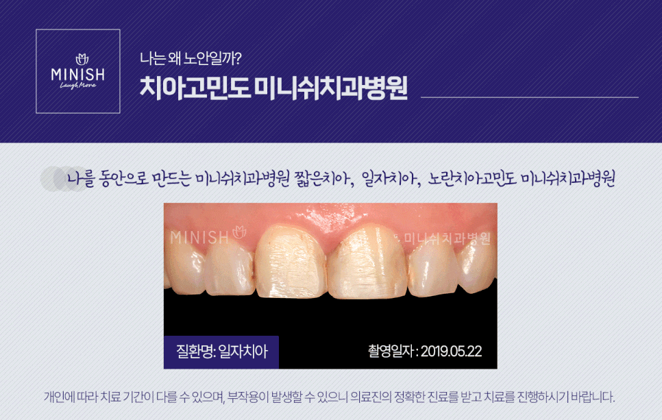 누렇고 짧은치아 개선법 관련 이미지 8