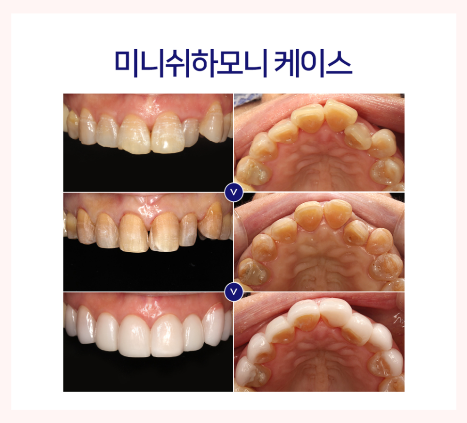 Is It Possible to Straighten Teeth in Just One Day? image 16
