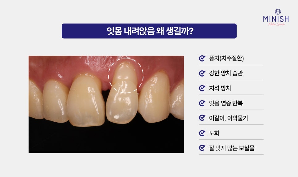 Causes of Receding Gums, Early Signs of Gum Disease, and When Gum Disease Treatment Is Needed image 2