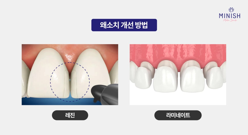 Small Teeth, Hypodontia: What Is a Healthy Way to Improve Them? image 4