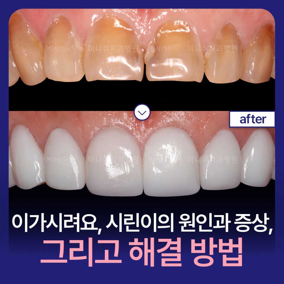 My Teeth Hurt When They’re Sensitive: Causes, Symptoms, and How to Resolve It image 1