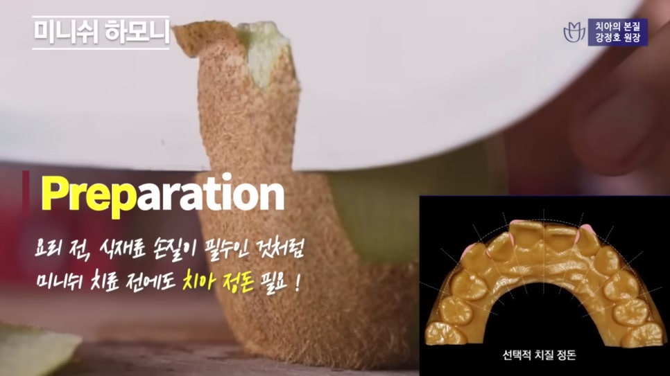 치아교정 앞둔 당신이 반드시 알아야 할 점 ② - 미니쉬하모니 관련 이미지 3