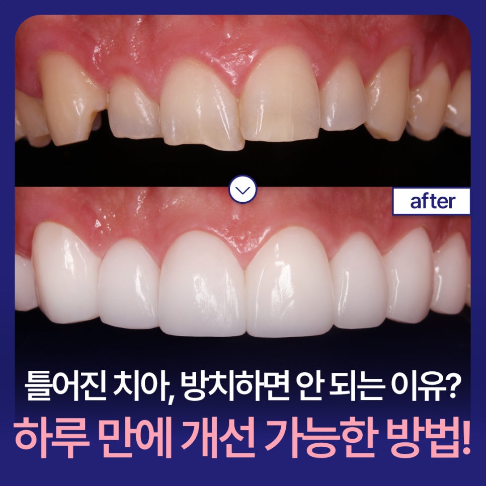 Why You Shouldn’t Leave Crooked Teeth Untreated? A Way to Improve Them in Just One Day! image 1