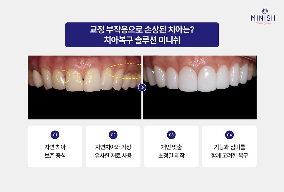 Why Do Orthodontic Side Effects Happen, and How Can You Recover Healthily? image 5